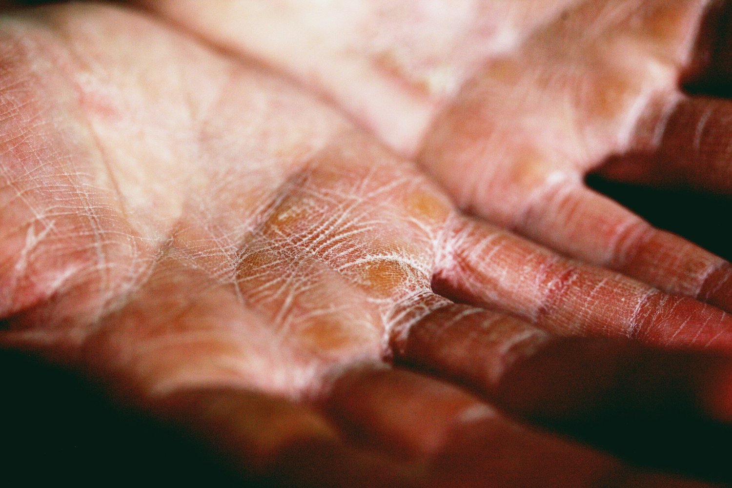 Close-up of dry, cracked skin on a hand