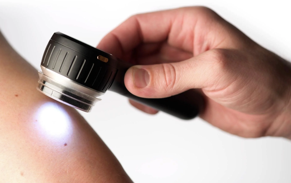 Dermatoscope examining a mole during a skin check